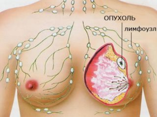 Рак груди -грозное заболевание, которое унесло много жизней.